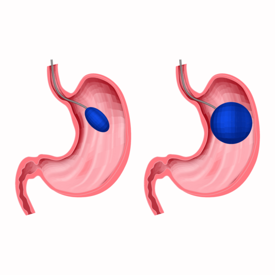 Eine Graphik von dem Einsetzen eines Magenballons.