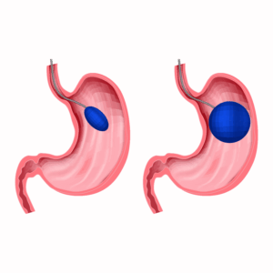 Eine Graphik von dem Einsetzen eines Magenballons.