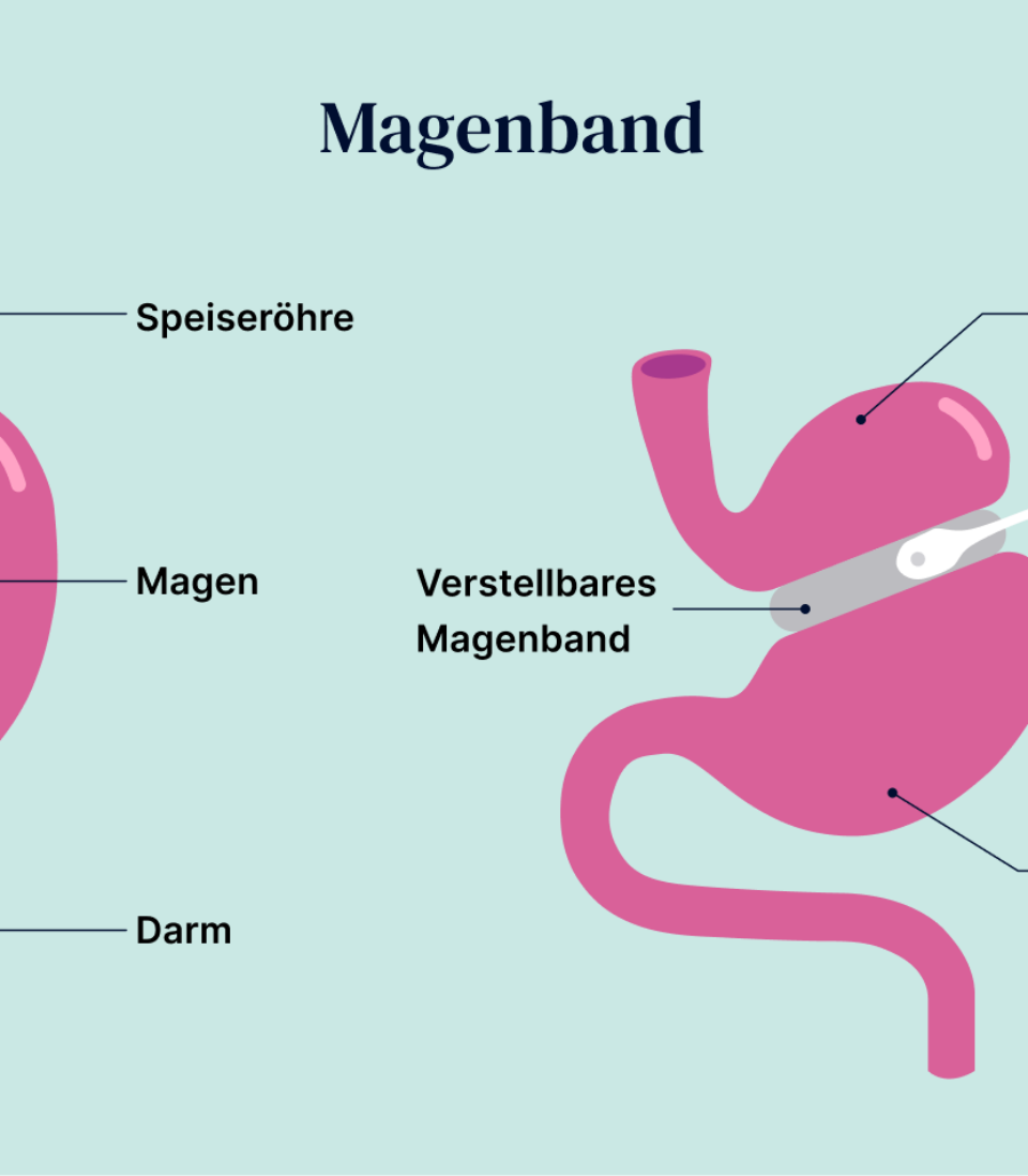 Magenband: Ist die OP für mich geeignet? | Oviva
