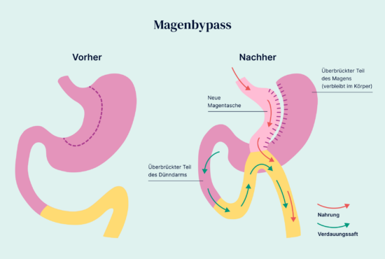 Magenbypass vorher nachher Grafik